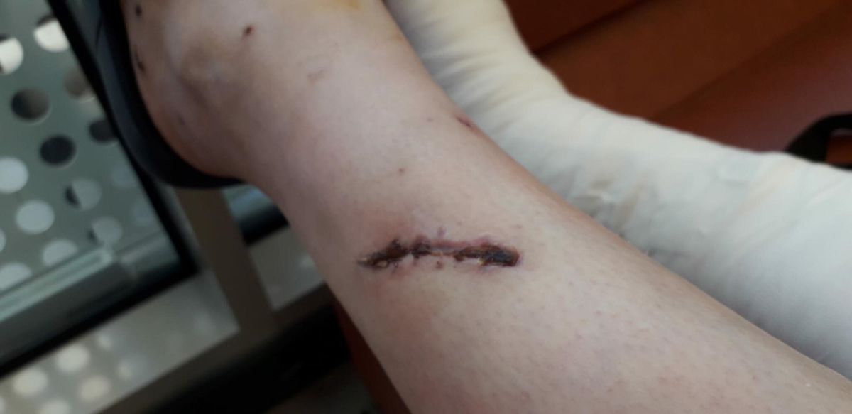 Köpek Saldırısında Yaralanan Koruma Savcılığa Başvurdu