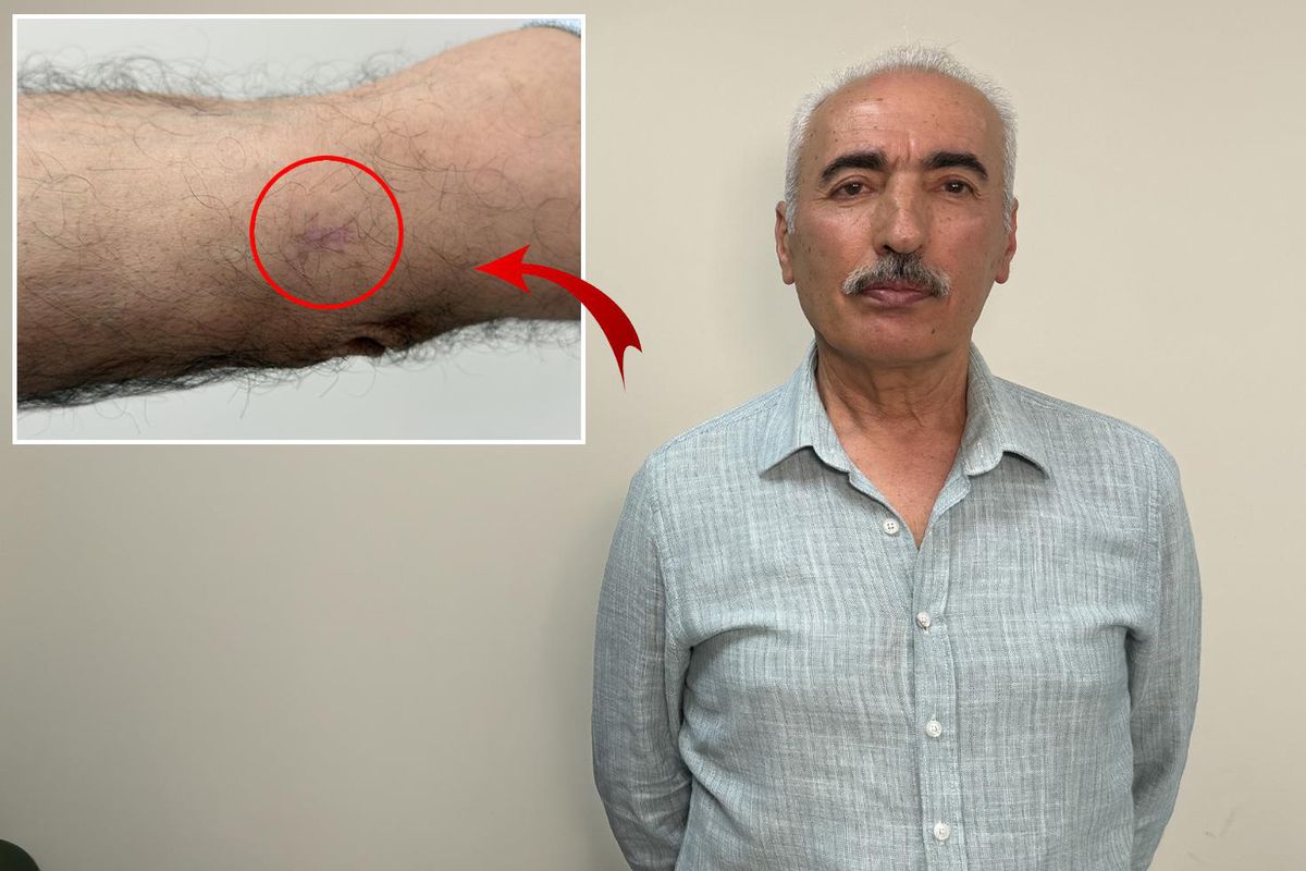 Kolundaki 1 santimetrelik yara kanser çıktı